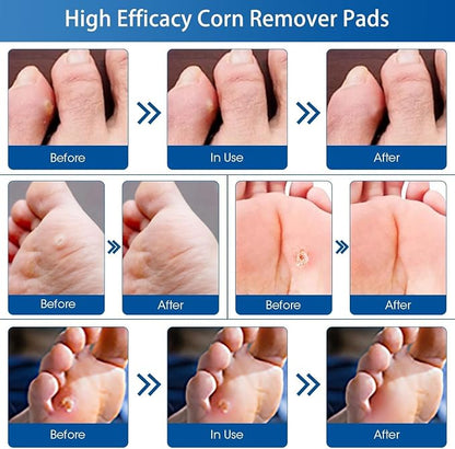 48 Count Corn Removal Pads for Feet and Toe, Corn Feet Remover for Extra - Image 7